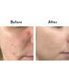Lavido: Thera Intensive Clarifying Spot Treatment